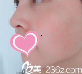 做假体隆鼻视频,视频带你领略美丽蜕变之旅